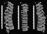 Brucellosis vertebrae